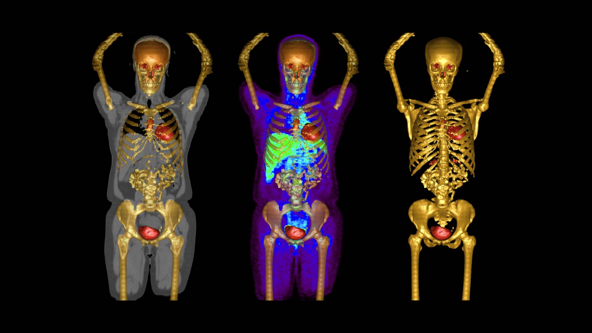 Surface Rendering PET/CT
